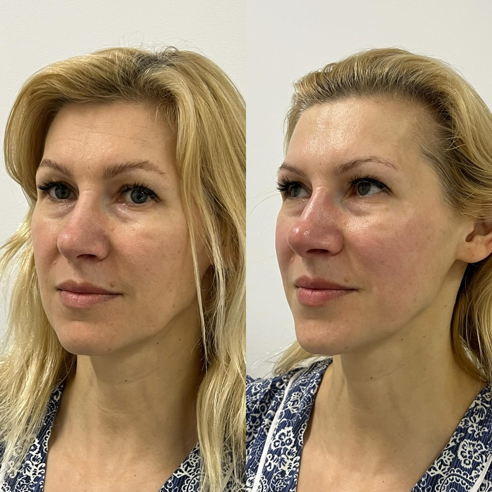 Lymphatic Facial Program (5 Sess) at Healthy skin by Alvina in Highland Park, IL