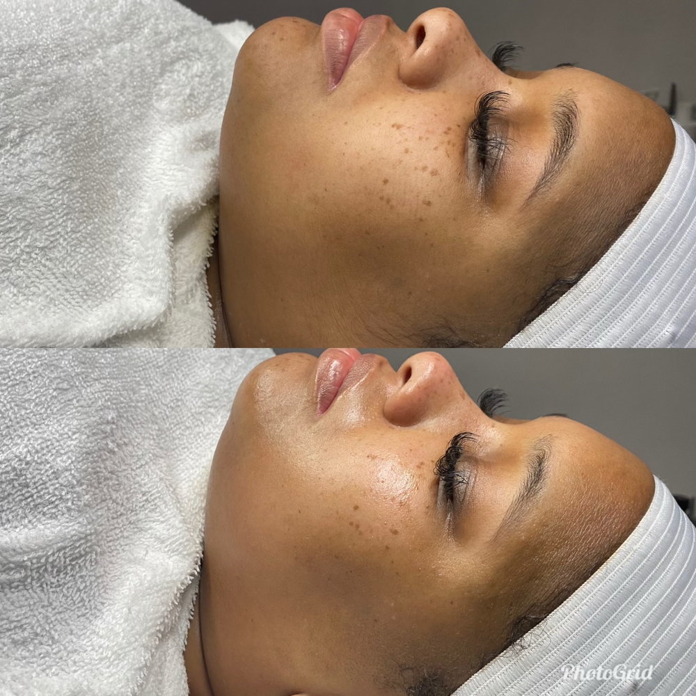 Dermaplaning Facial