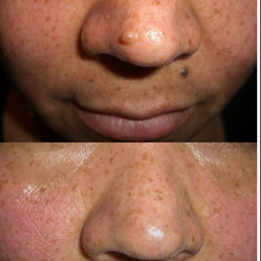 Fibromas Removal at Serenity Aesthetics by Denise in St. John’s, FL