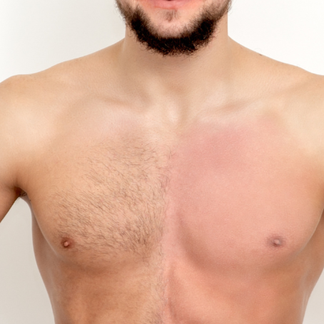 Full Chest at Bareline Aesthetics in Brea, CA