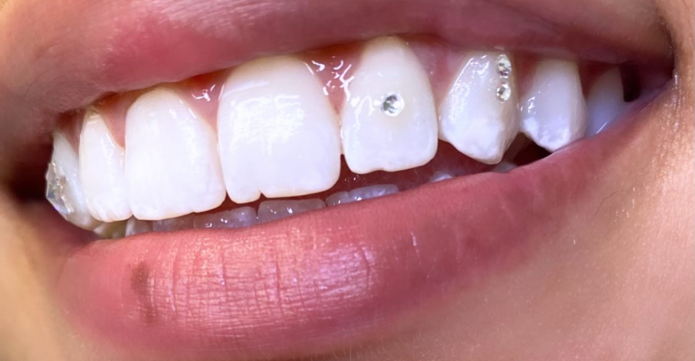 Tooth Gems ✨