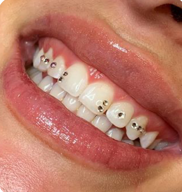 Tooth Gems 5-8