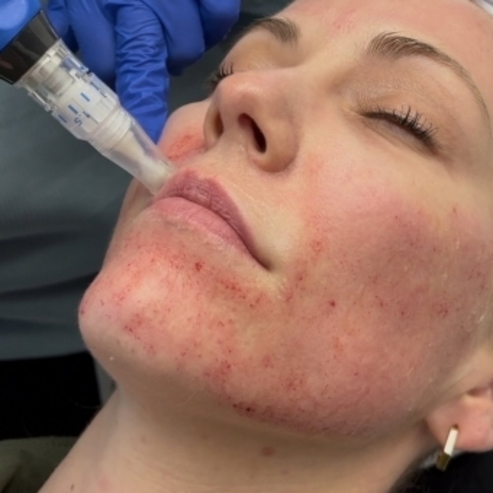 Microneedling at Andrea Godsey in Mesa, AZ
