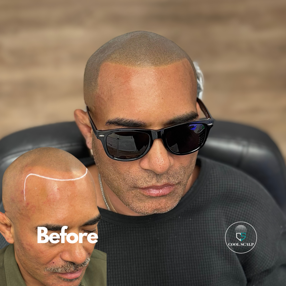Scalp Micropigmentation Correction
