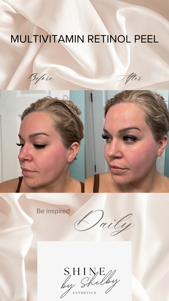 Multivitamin Retinol Peel