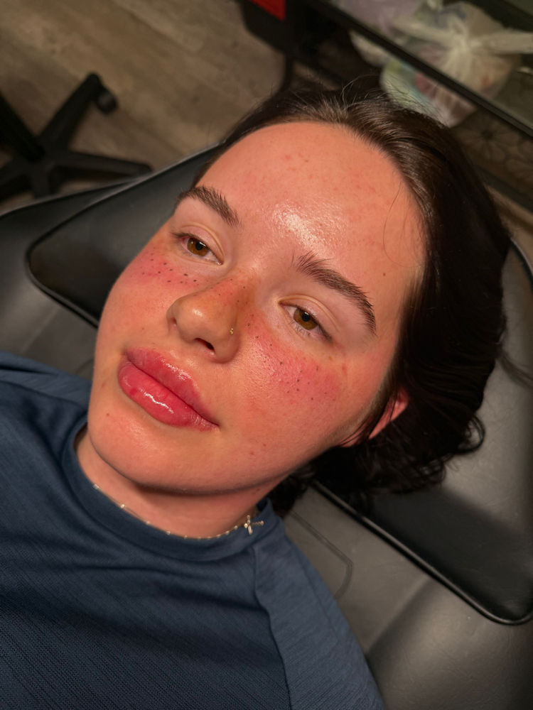 Freckles