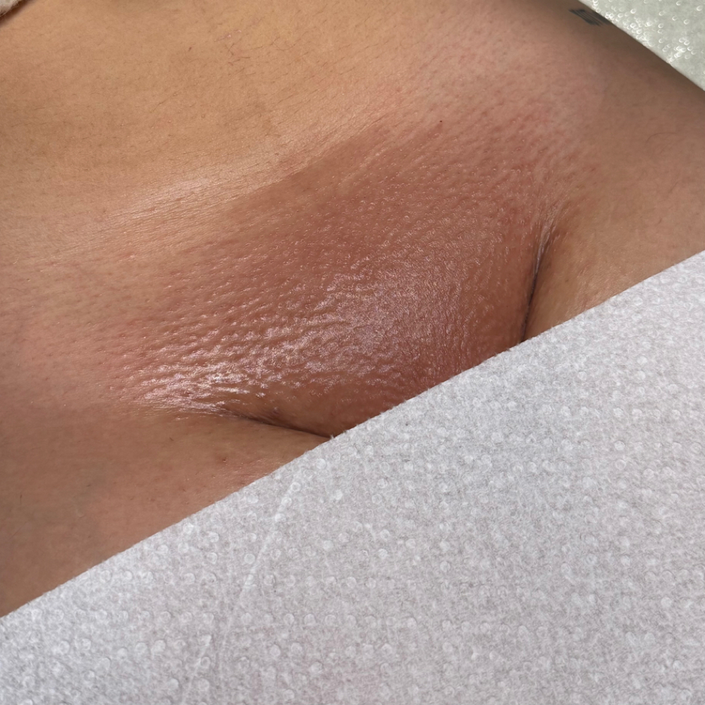 Brazilian Wax 4-6 Weeks at Skinly Beauty in Bakersfield, CA