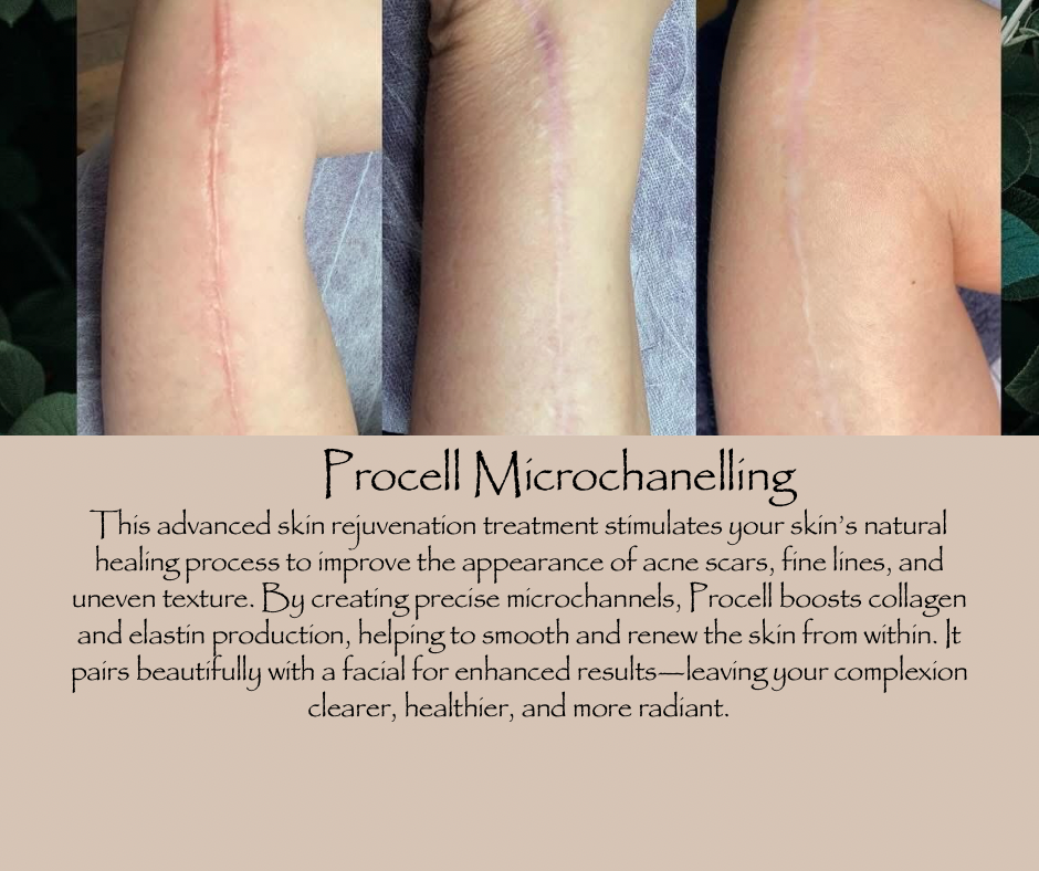 Procell Microchanneling