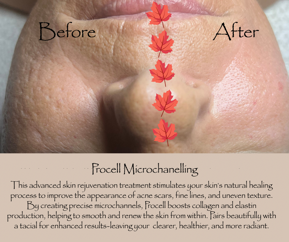 Procell Microchanneling