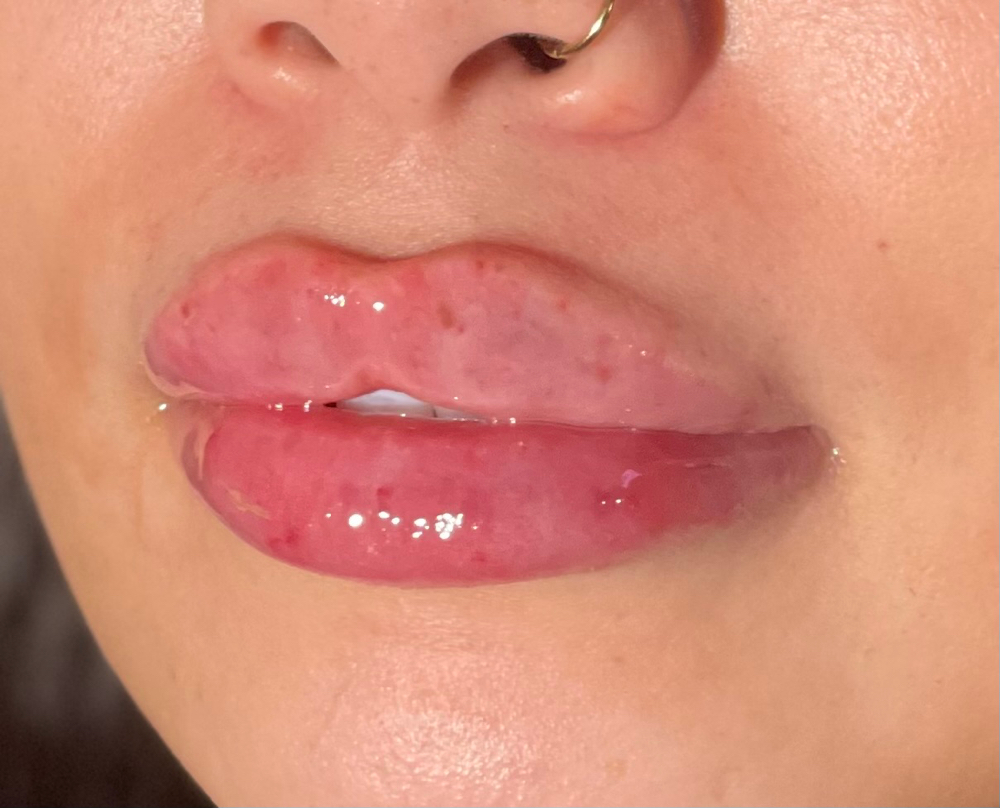 Lip REHAB