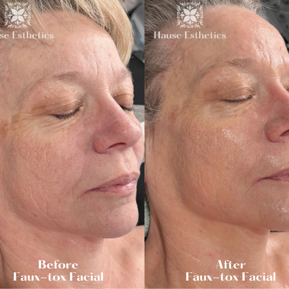 “Faux-tox” Facial at Hause Esthetics in Morristown, TN
