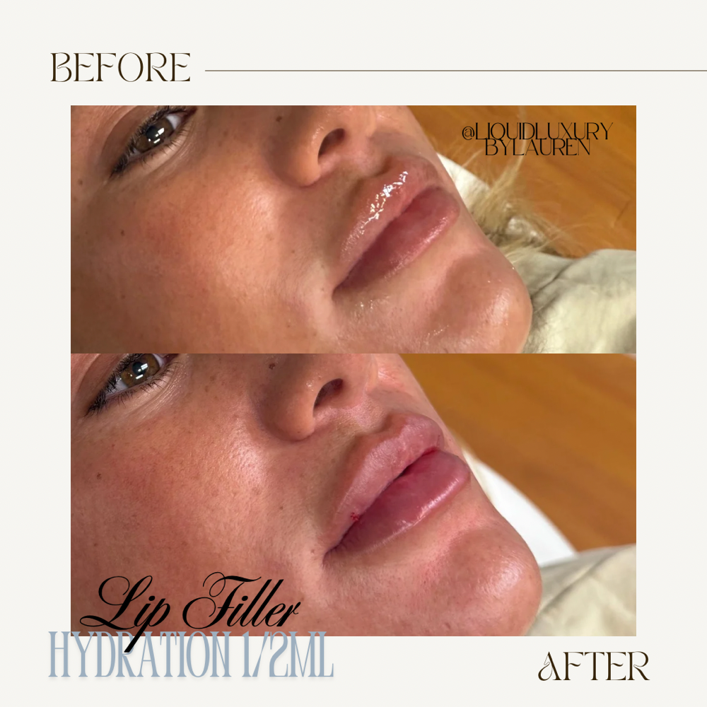 1/2 Syringe Lip Filler