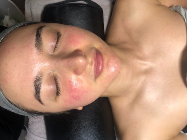 Sensitive Skin Facial