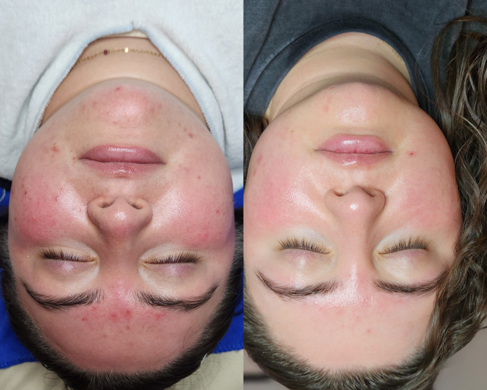 Acne Clearing & Healing Facial