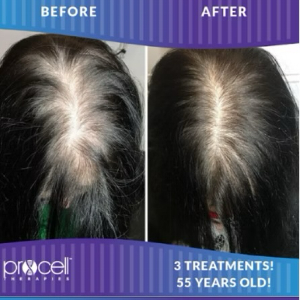 Procell Microchanneling - Hair at Lumos Aesthetics & Wellness in Louisa, KY