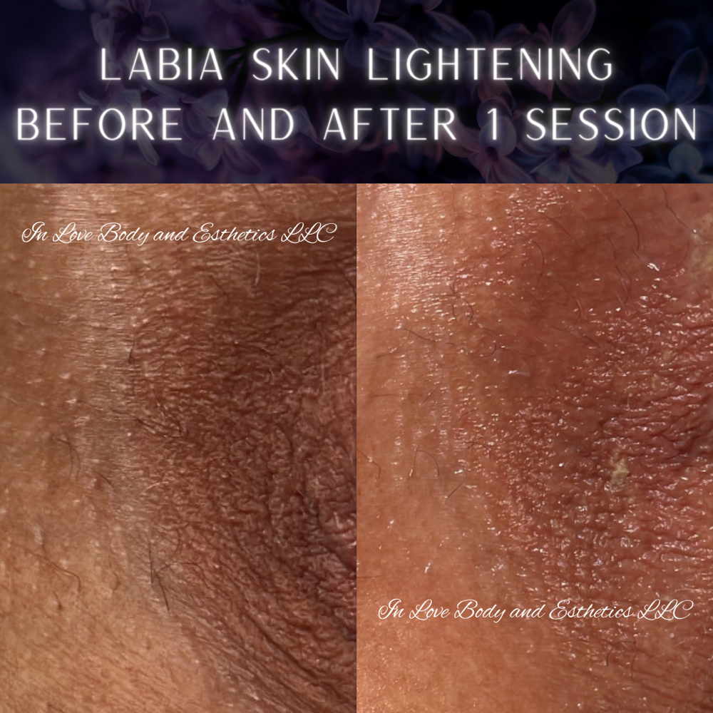 Labia Skin Correction