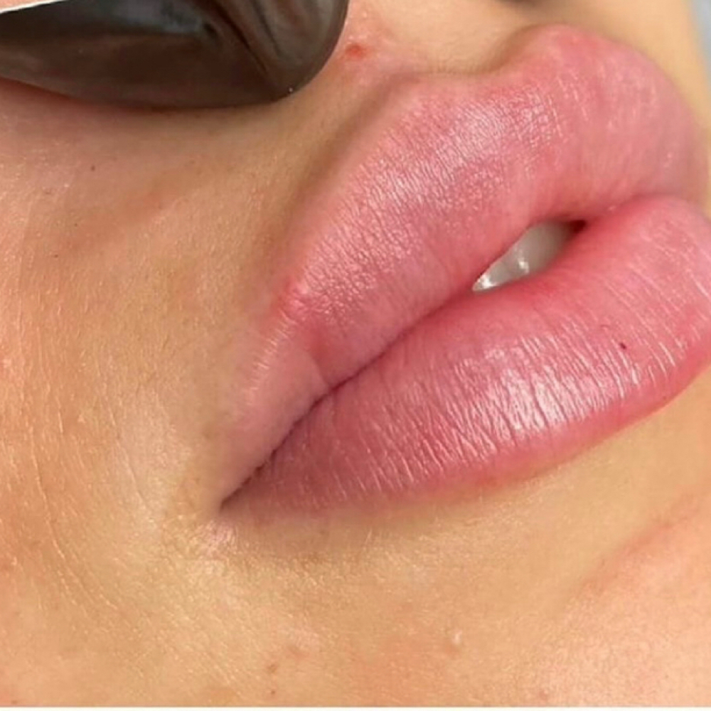 2ML Micro-Needle (ONLY) at THE LIP FACTORY in Raleigh, NC