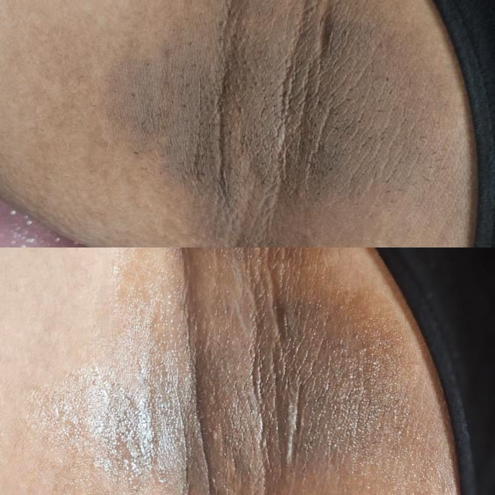 Underarm Skin Correction