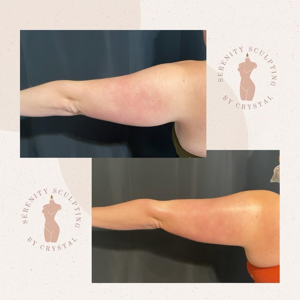 Arm Refine at Serenity Sculpting in Madera, CA