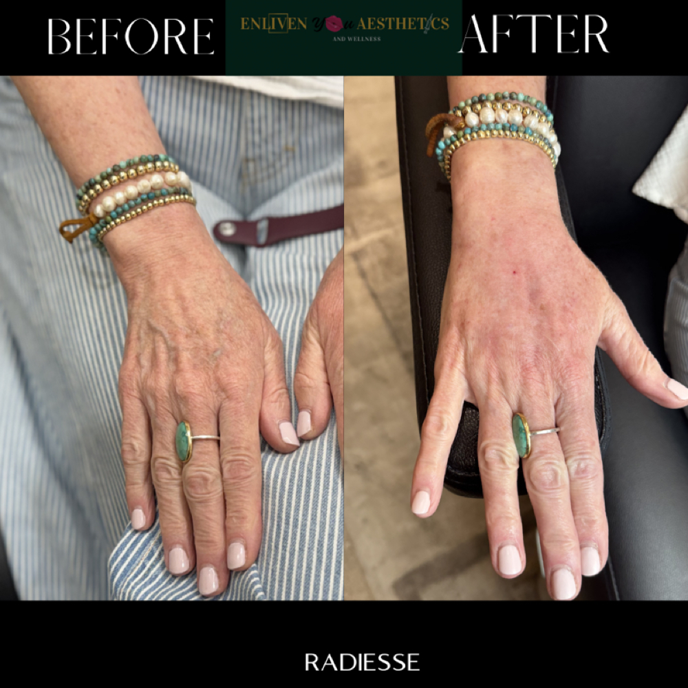 Radiesse Hands at Enliven You Aesthetics & Wellness in Dallas, TX