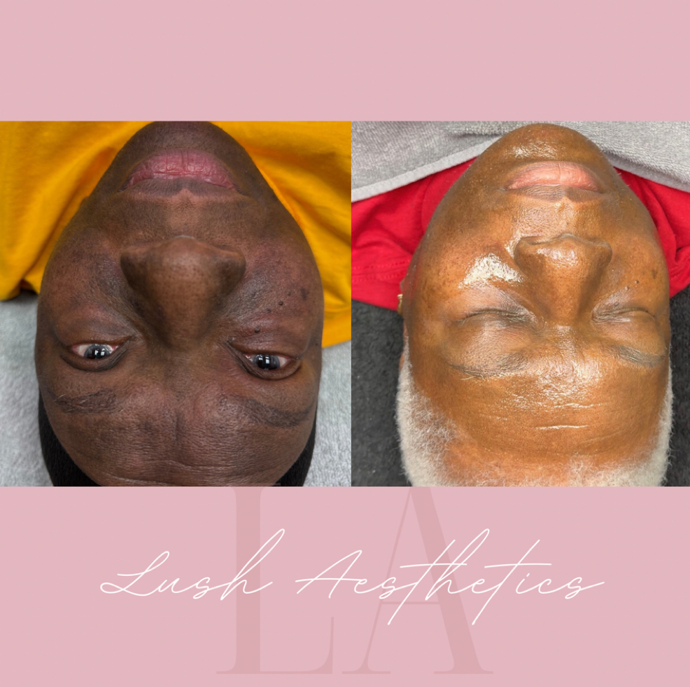 New Client Corrective Facial at Lush Aesthetics in Englewood, OH