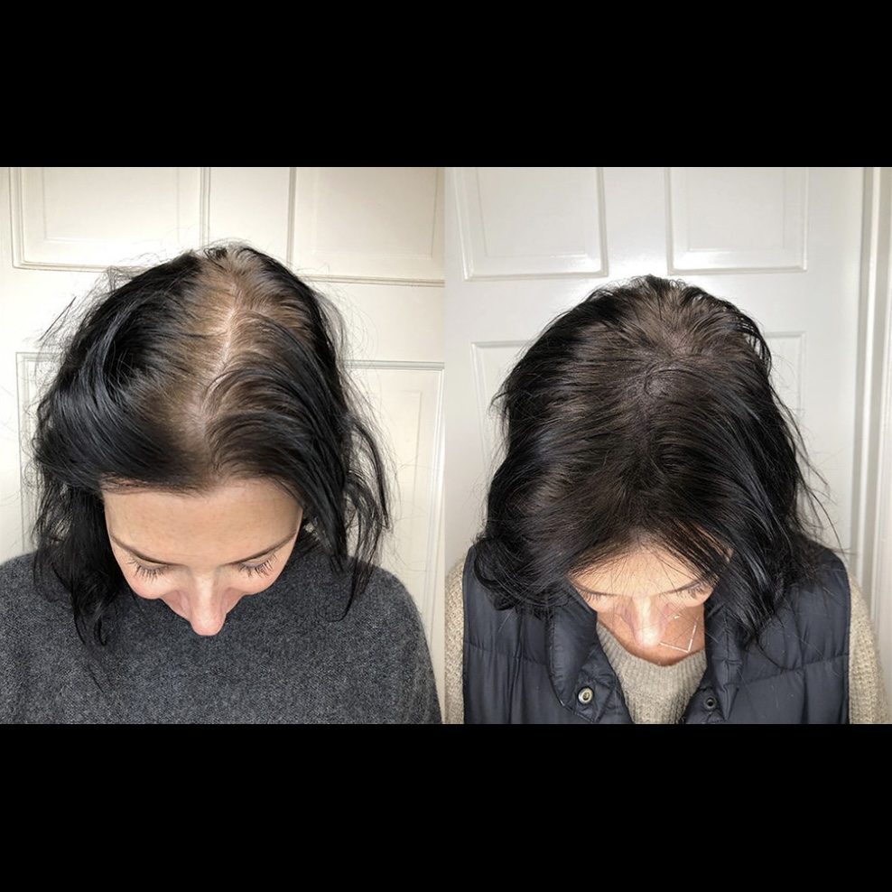 Scalp M Pigmentation (CONSULTATION)