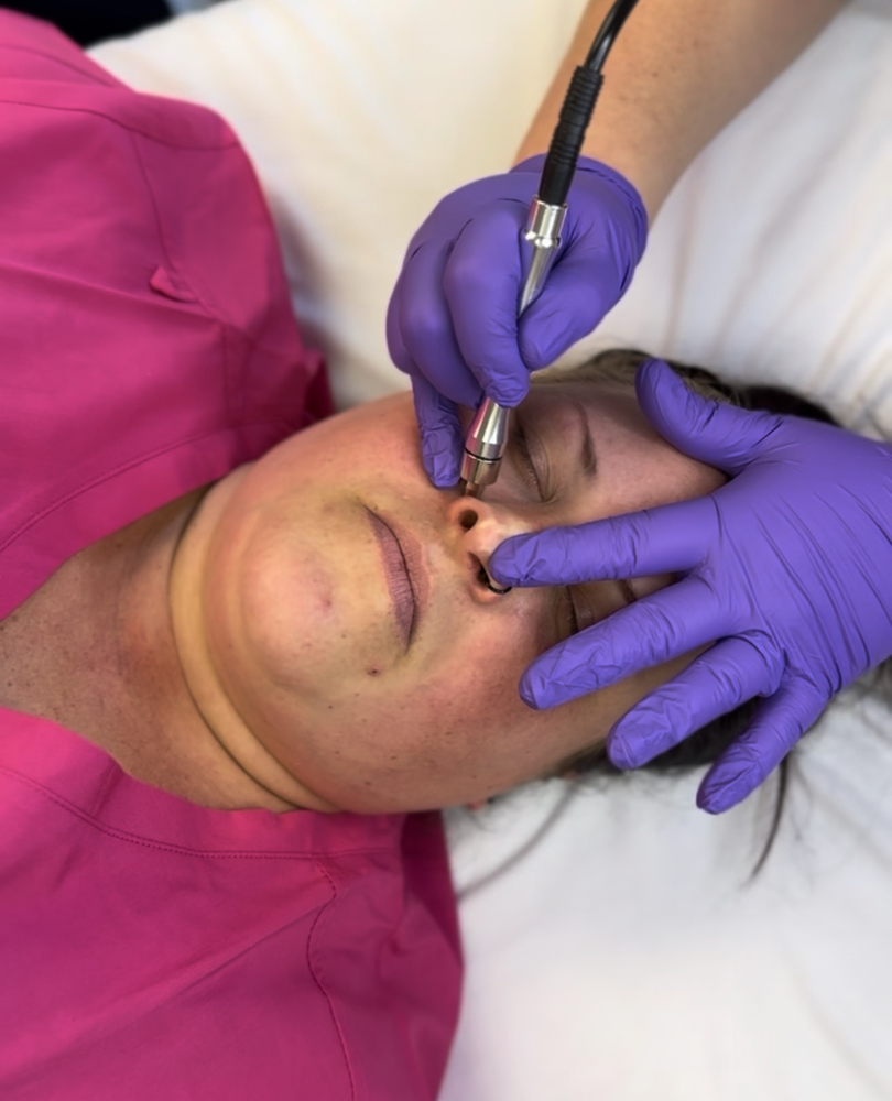 Microdermabrasion Add-On