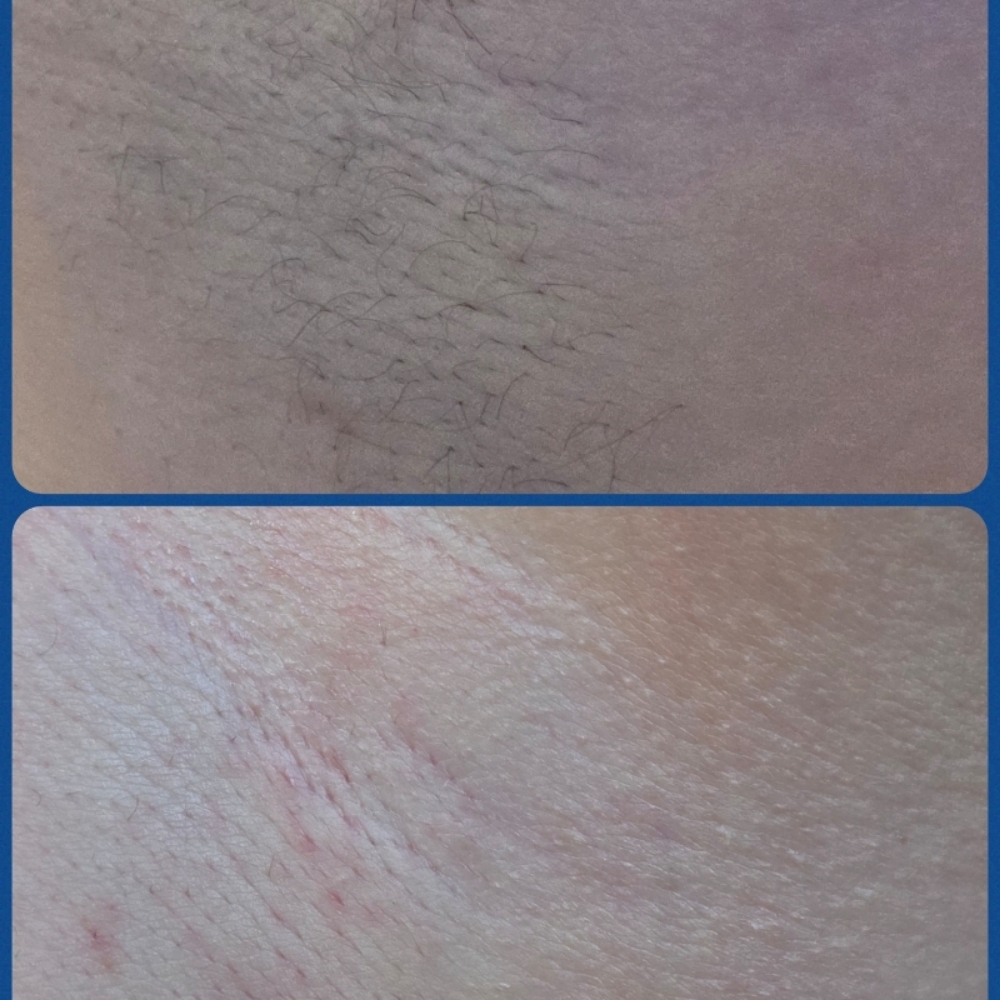 Underarm Waxing at PURE ELEGANCE in Lubbock, TX