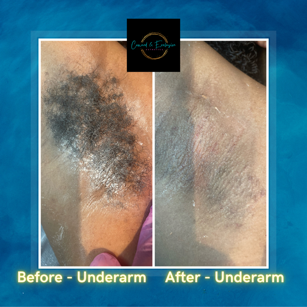 Underarm Hair Removal at Crowned Exclusive Esthetics in Kansas City, MO