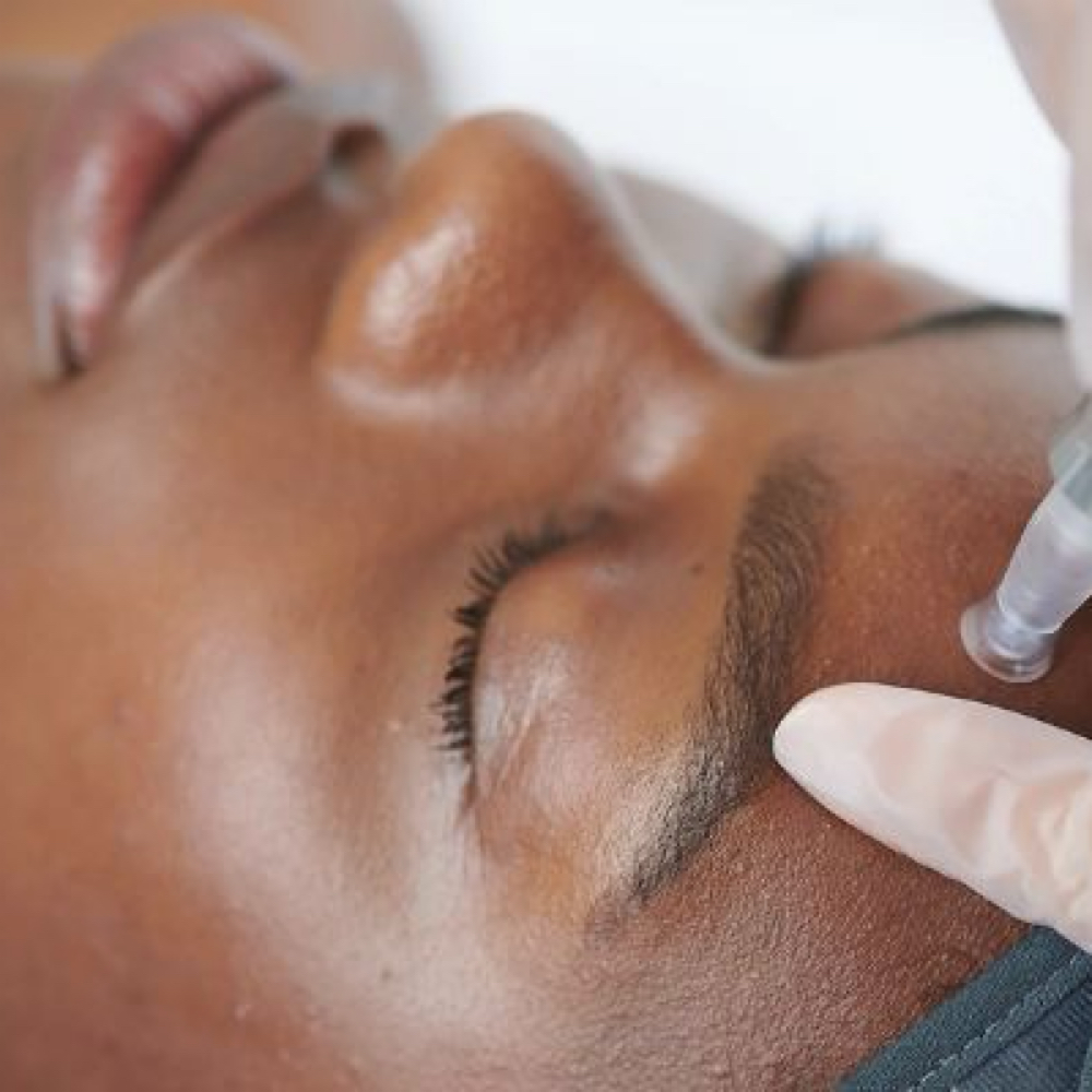 Standard Microneedling Package 3