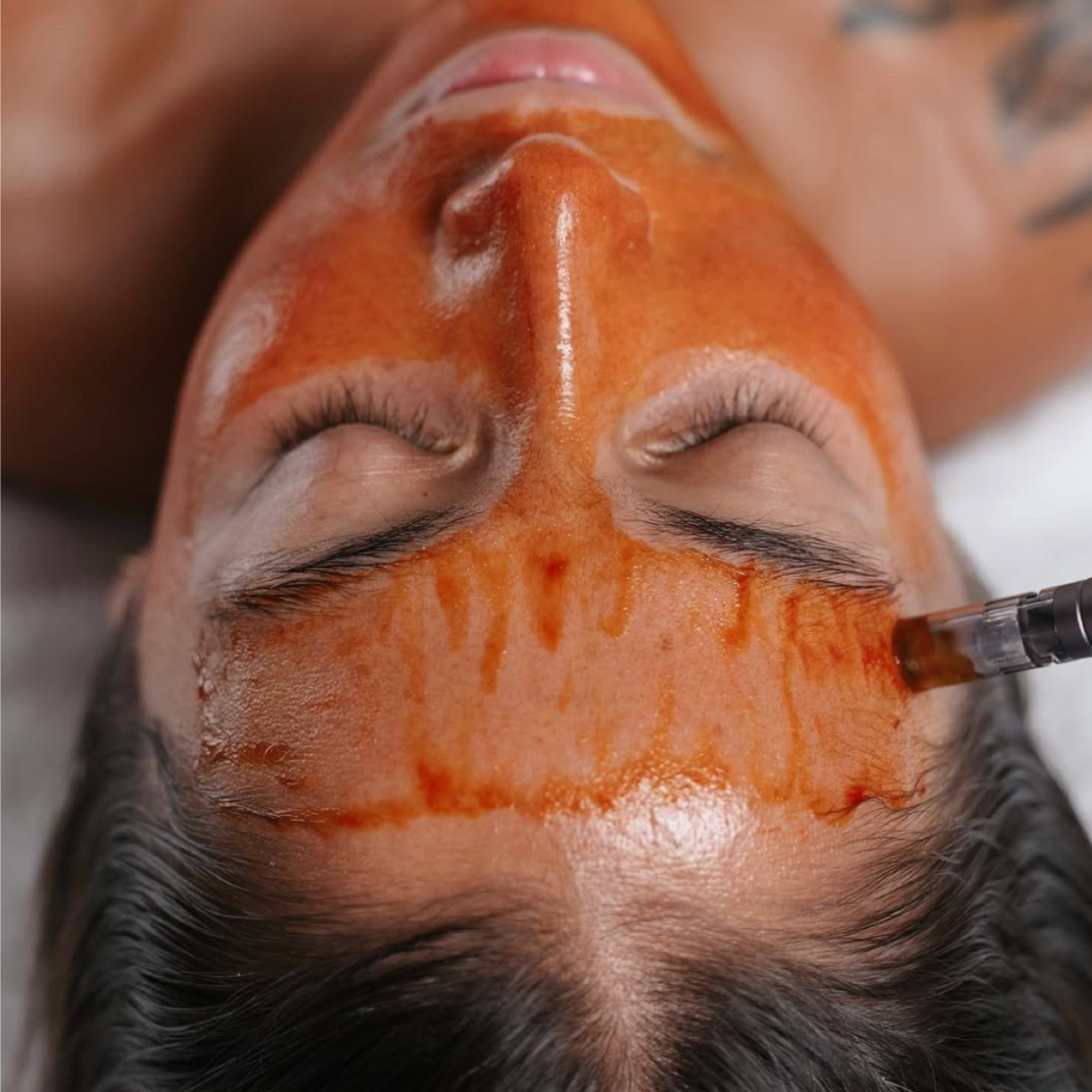 The Microneedling Treatment at The Glo Haus Atlanta in Atlanta, GA