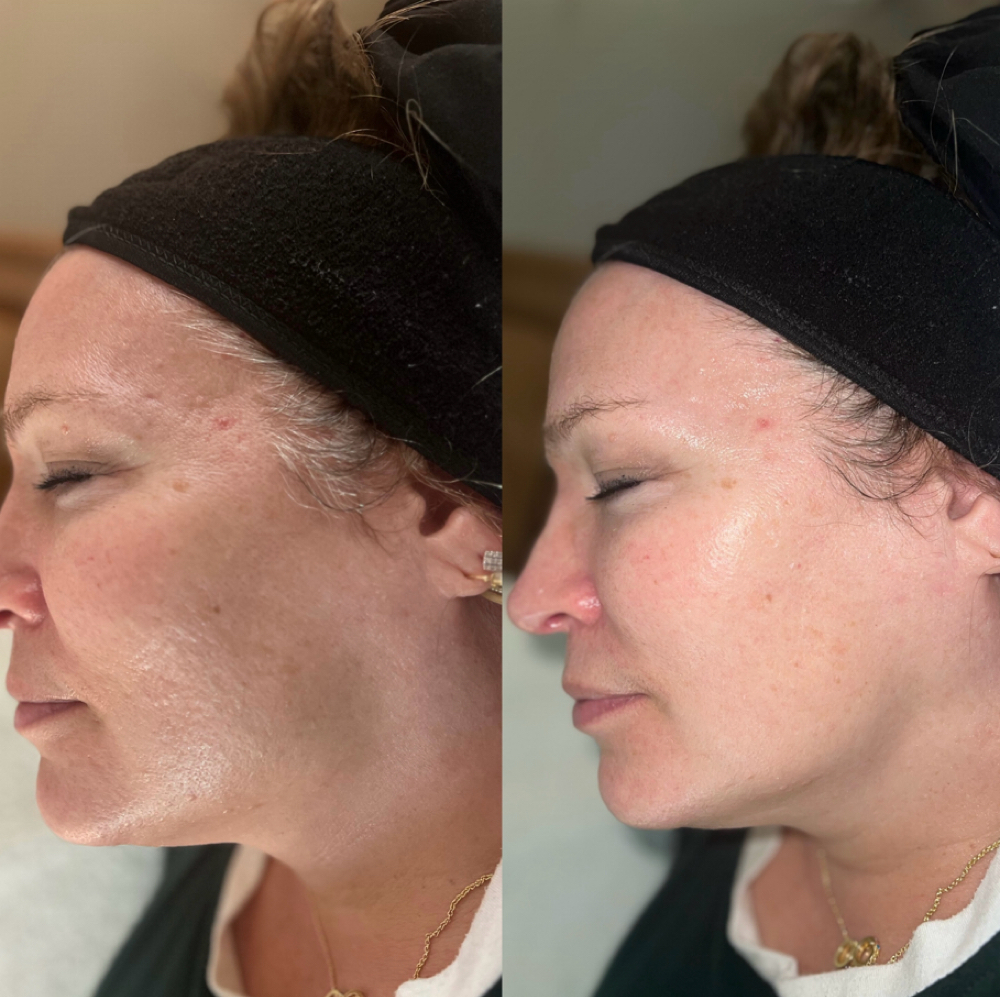 Express Dermaplane at Native Complexions in Winchester, KY
