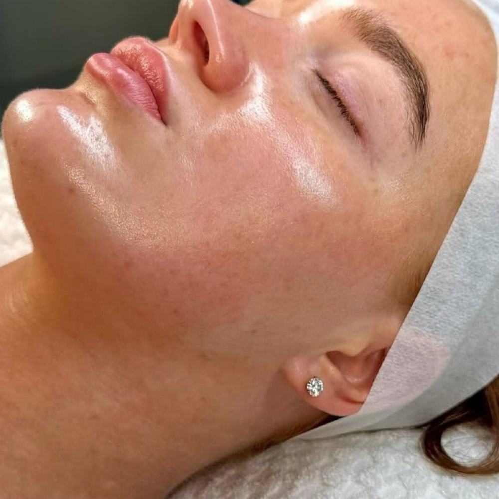 Acne Facial (Extractions) at Aesthetics By Aleigha in Florence, SC