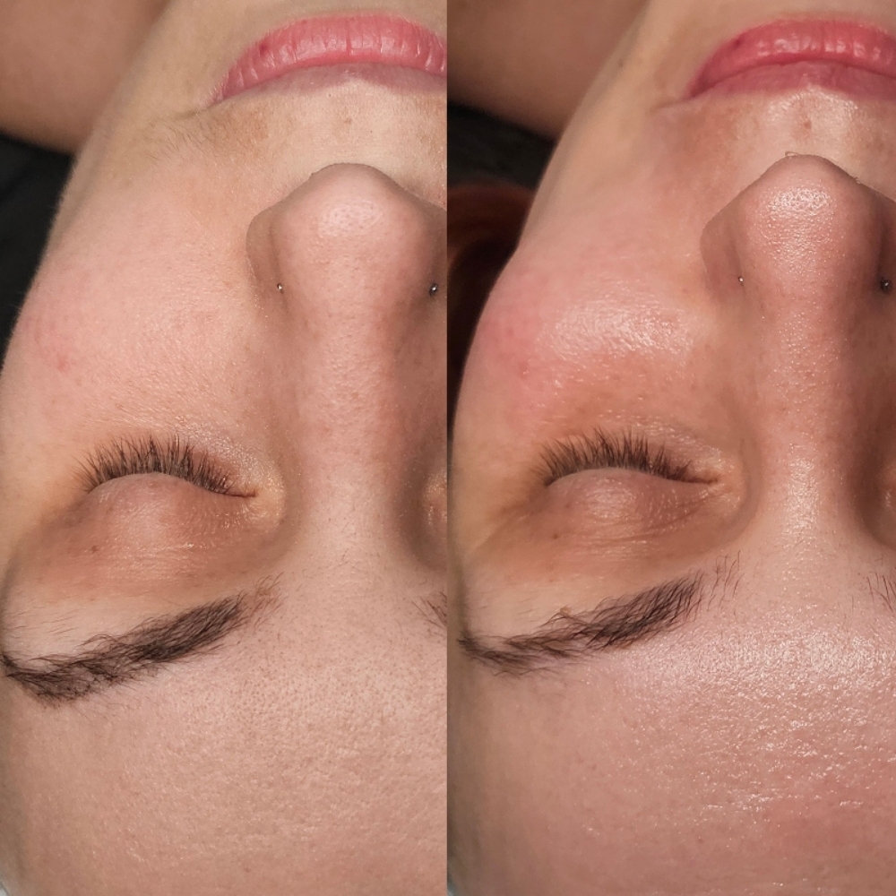 The Teen Dream Facial at Aligned Beauty & Wellness in Davenport, IA