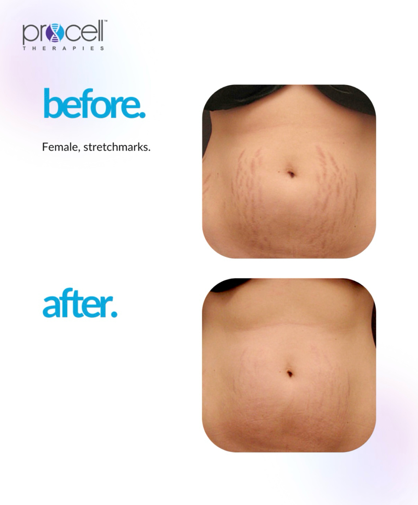 Procell Therapies Stretch Marks