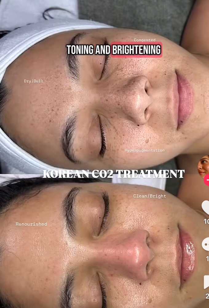 Korean Carboxy Facial (CO₂ Therapy)