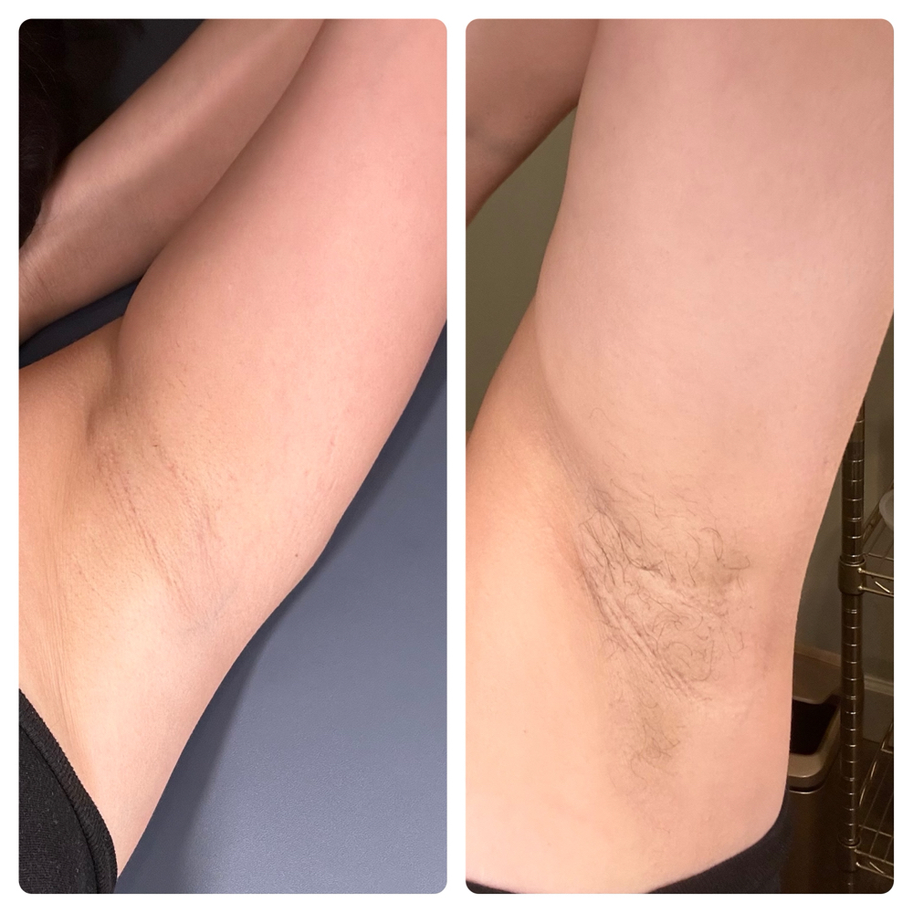Under Arm Care