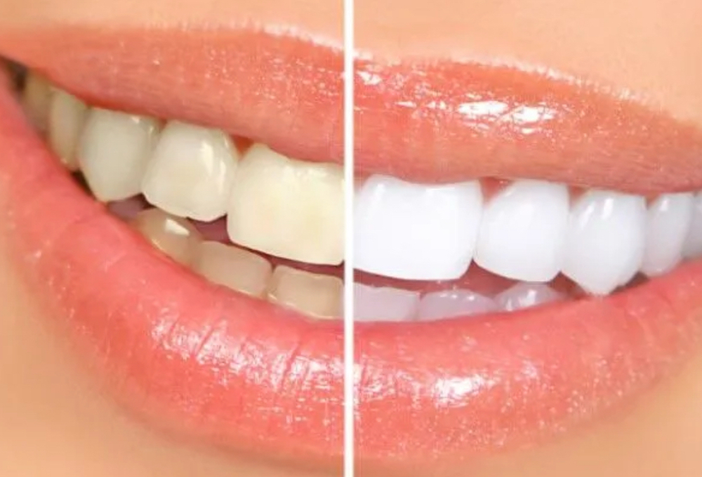 Teeth Whitening Treatment