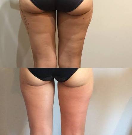 Body Sculpting & Slimming Legs