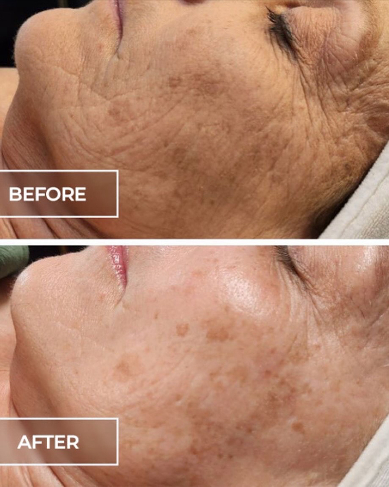 Golden Hour SWiCH Treatment