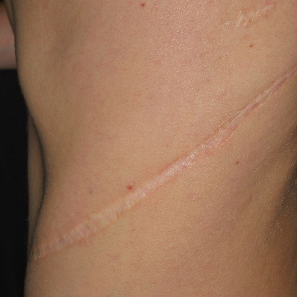 Scar Resurfacing Technique at ALOS STUDIO in BORING, OR
