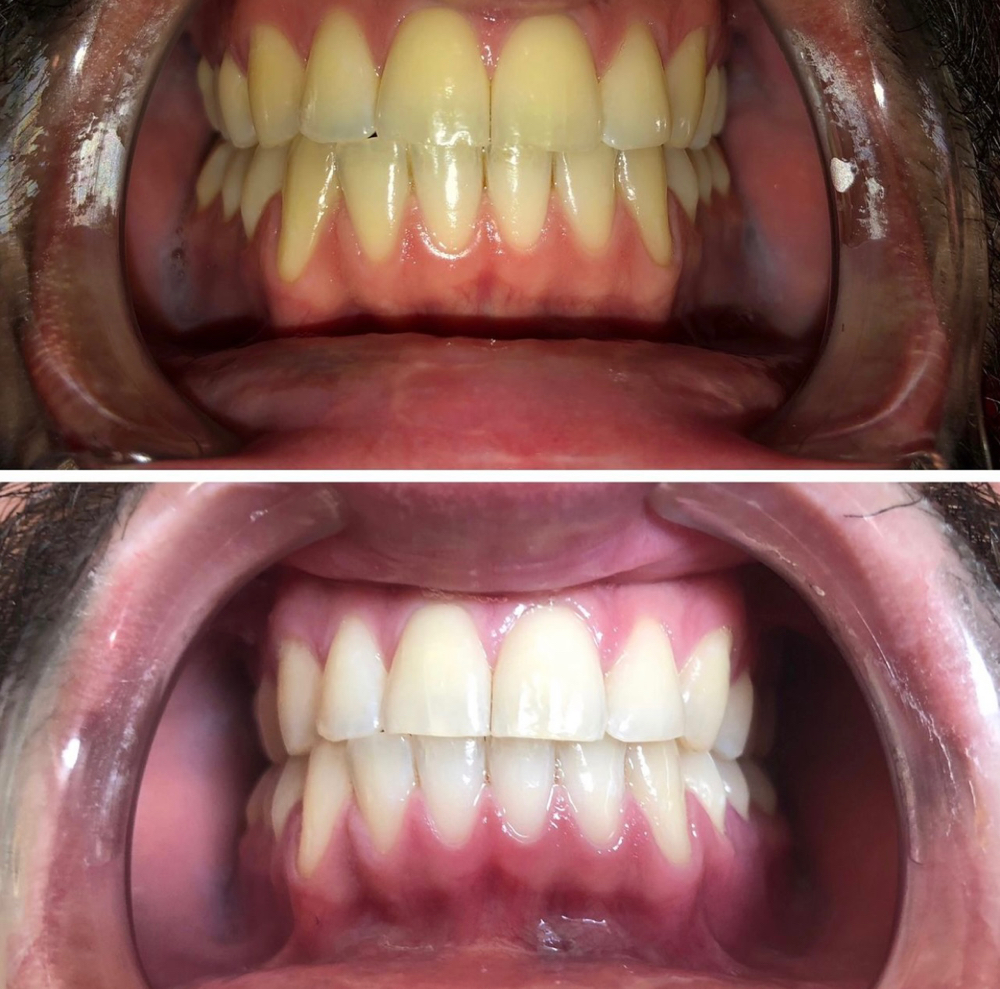 Teeth Whitening