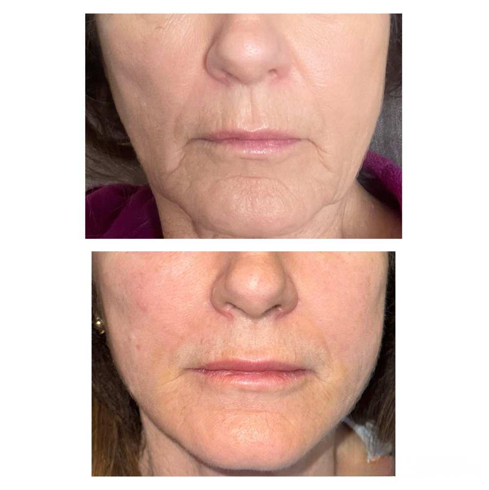 Dermal Filler Maintenance