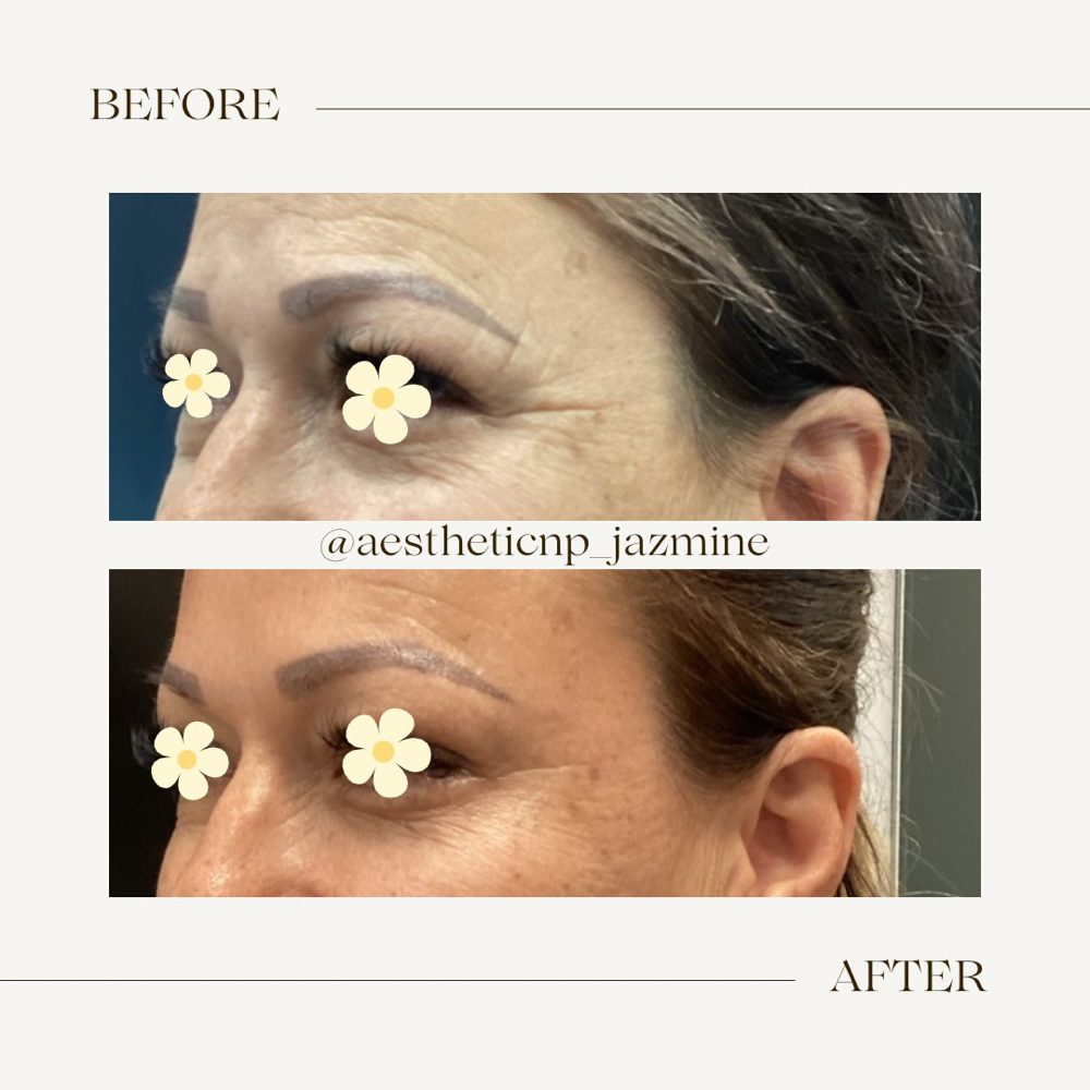 Crows Feet - Eye Focus at Amoris Aesthetic in Hillsborough, NJ