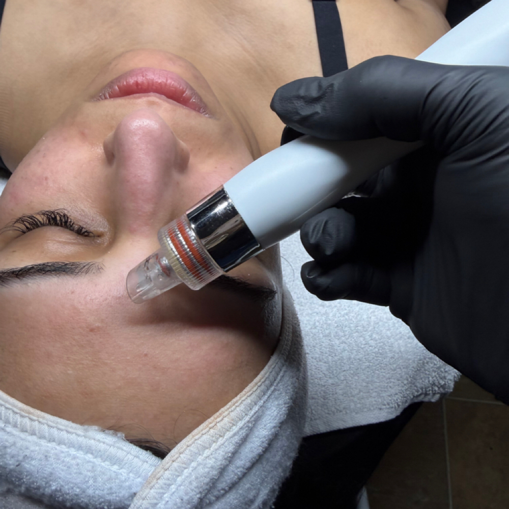 Hydrafacial at Radiant Eyes & Aesthetics in Petal, MS