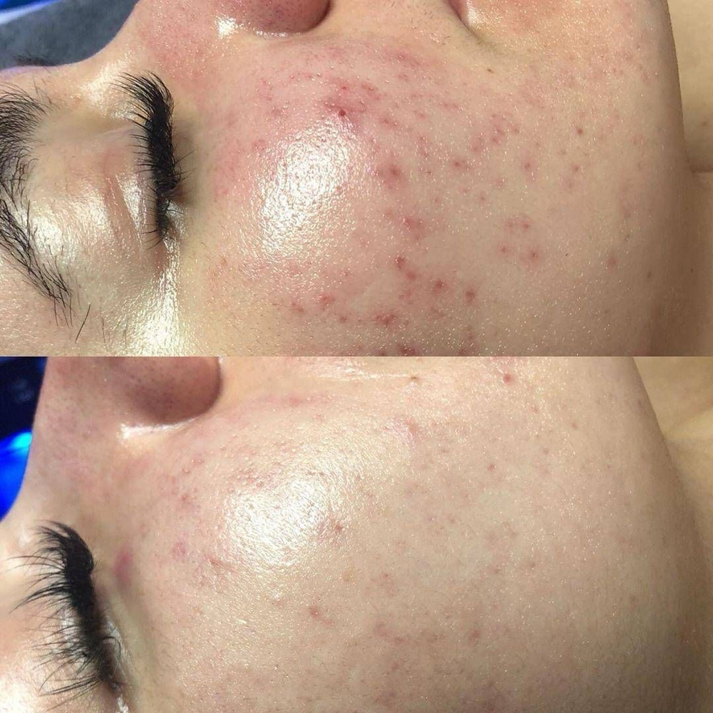 Acneic Skin Treatment