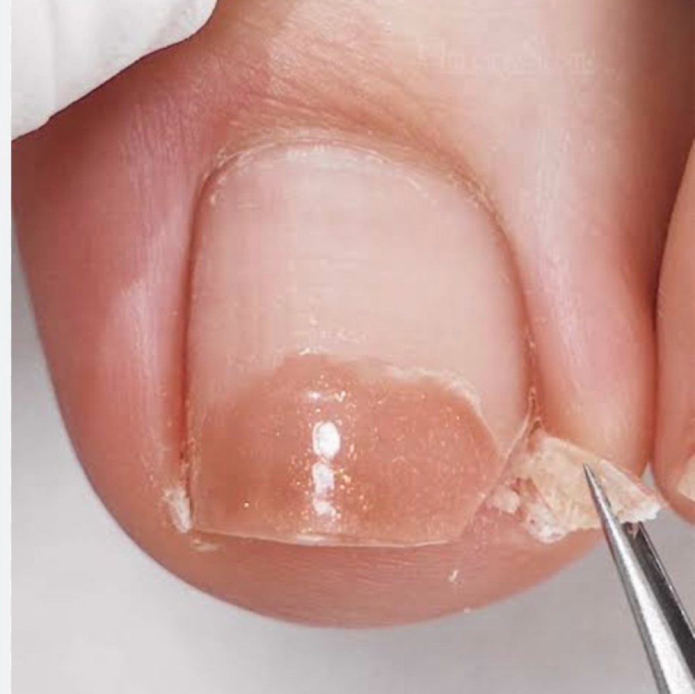 Servicio Uñas Encarnadas at Gardenias Beauty Salon in North Charleston, SC