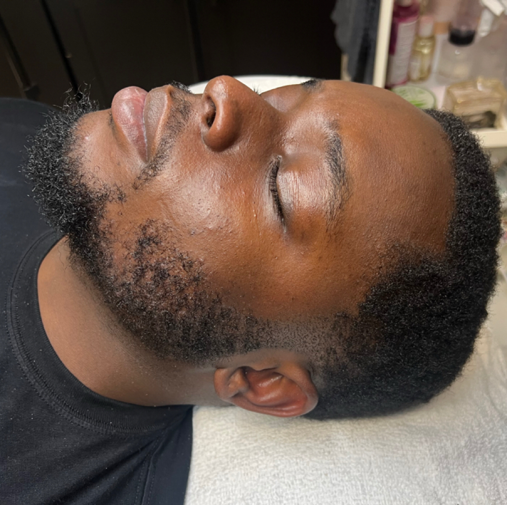 Microdermabrasion Facial