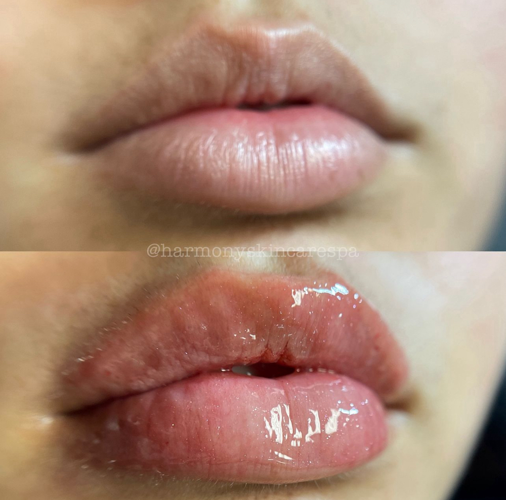 Lip Filler W/ No Needless