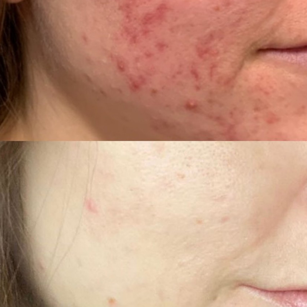 Neo Aerolase Acne Scarring at Beauty Skin and Laser Studio in Hauppague, NY